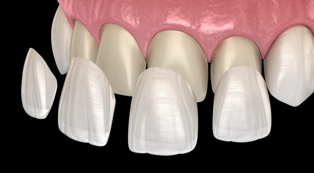 Dental Veneers in KL