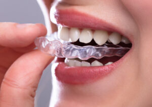 invisalign kl