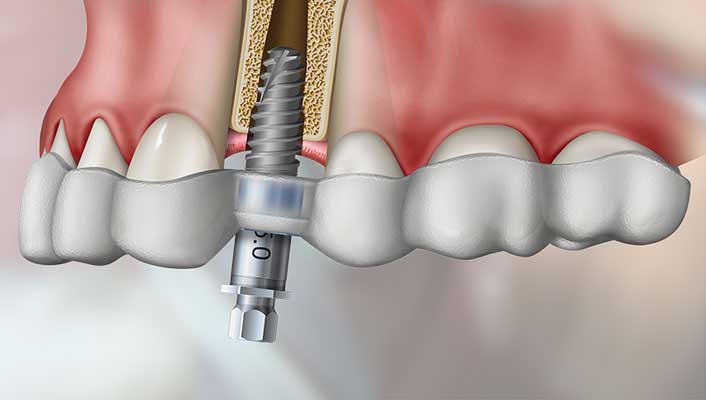3D Guided Implant
