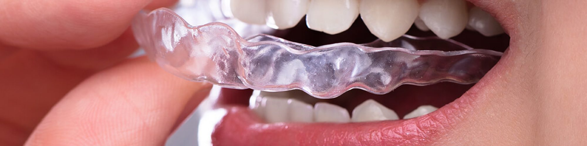 invisalign-kl